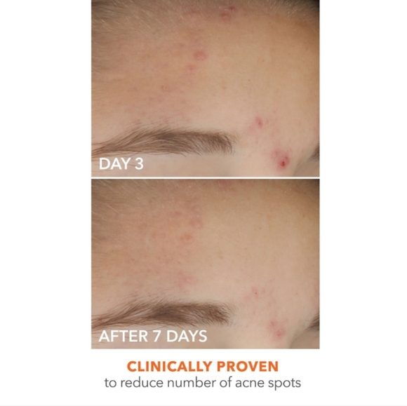 NIB DR.DENNIS GROSS ALPHA BETA 2% ON THE SPOT ELIMINATOR ACNE TREATMENT GEL - Picture 8 of 16